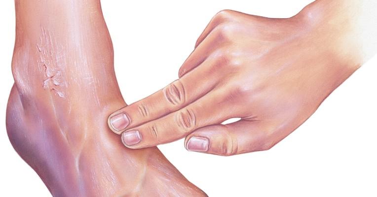 دراسة: فيروس كورونا قد يسبب الغرغرينا