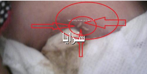 كلثوم ..  فتاة اردنية أكل الدود جسدها اثر مرض نادر لم يعرف له الطب طريقاً ..  صور