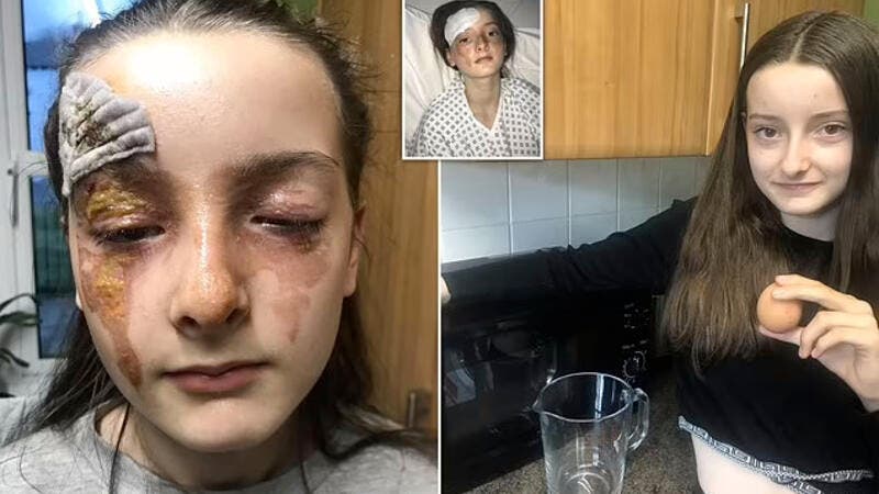 بصور مروعة  ..  طفلة تتحوَّل إلى دراكولا بعد انفجار بيضة في وجهها 