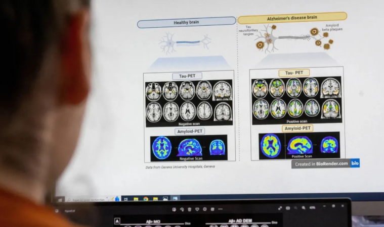 اختراق علمي قد يوقف مرض الزهايمر قبل بدايته