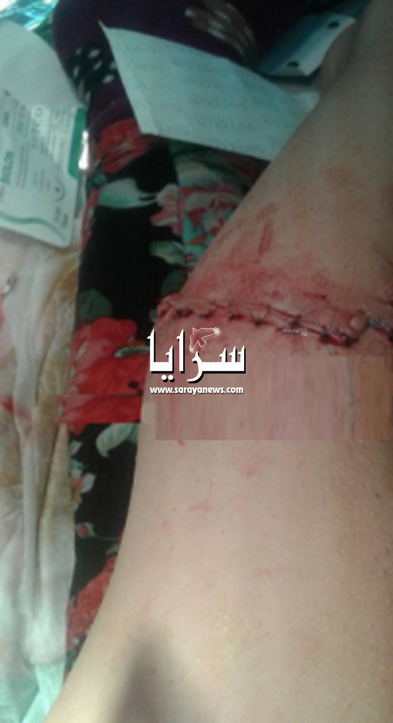 عجلون : اصابة اربعينية بجروح وكسور جراء سقوطها بشارع وعر  ..   وبلدية  كفرنجة تماطل باصلاح الطريق  ..  صور