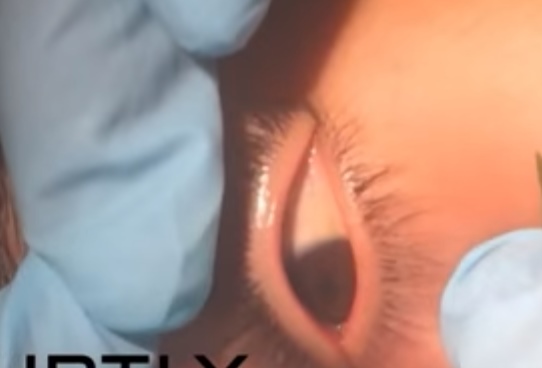 بالفيديو  ..  طبيب يخرج دودة طويلة من عين مريض