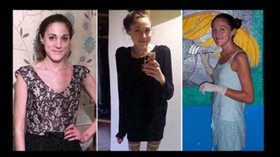 بالصور  ..  أشرس معركة ضد فقد الشهية: فتاة لم تأكل منذ عام