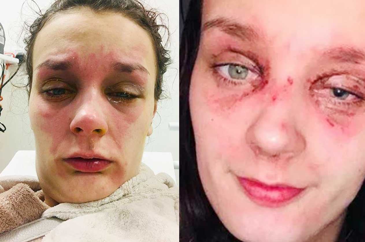 بيضة في الميكروويف تفقد فتاة بصرها ..  وتحرق جلدها
