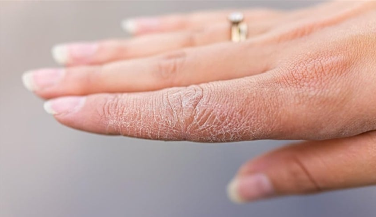 بشرتك تكشف الخطر ..  علامات مبكرة للسكري تظهر على الجلد