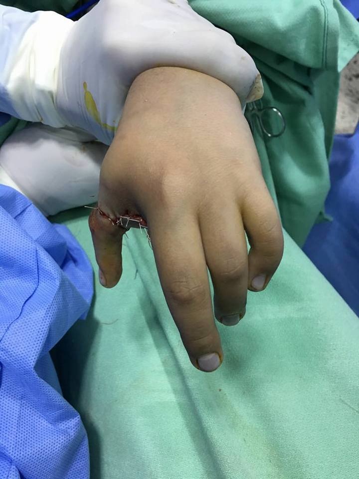 بالصور  ..  عملية زراعة نوعية لاصابع طفل بمستشفى المقاصد الخيرية