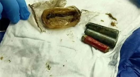 بالصور ..  إخراج 3 بطاريات من معدة شاب مصري بقيت داخل جسده لأكثر من عام