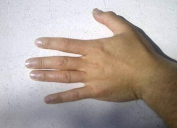 ما سبب الآلام في مفاصل الأصابع ومشط اليد؟