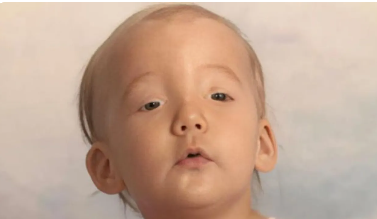 الفتاة التي لا ترمش ..  قصة تكشف معاناة مصابي متلازمة «تدلّي الجفن الخلقي»