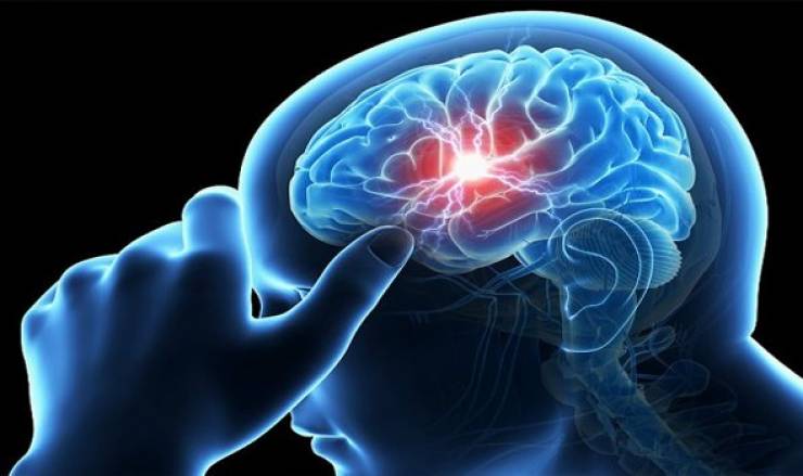 السكتة الدماغية قد تكون العارض الأول لكوفيد-19 لدى المرضى الأصغر سنا