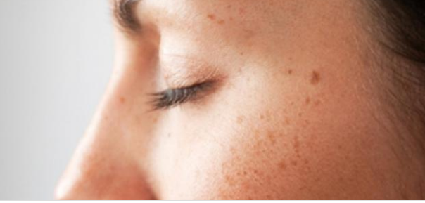 كيف تتخلصكيف تتخلص من حبة الخال