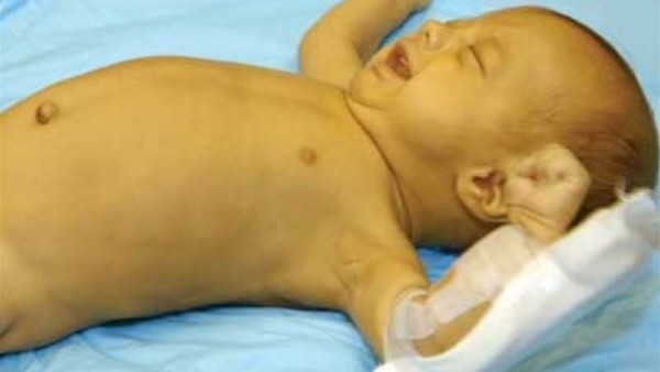 علاج الصفراء عند الرضع بالضوء يرفع خطر إصابتهم بهذا المرض الخطير   