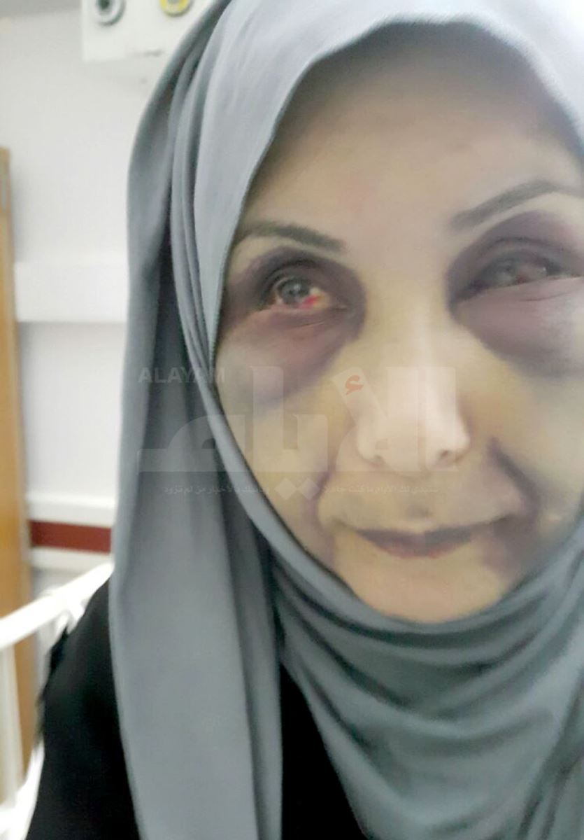 صور مؤلمة جديدة للسورية "زهراء" بضحية العنف الاسري بعد خروجها من المستشفى