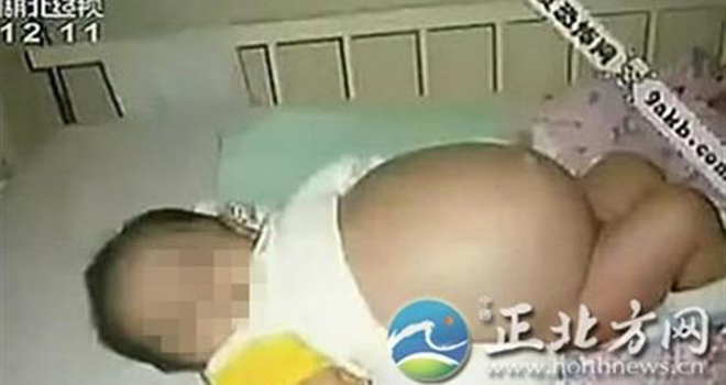 رضيع صيني يلد شقيقه بعملية قيصرية! .. صورة