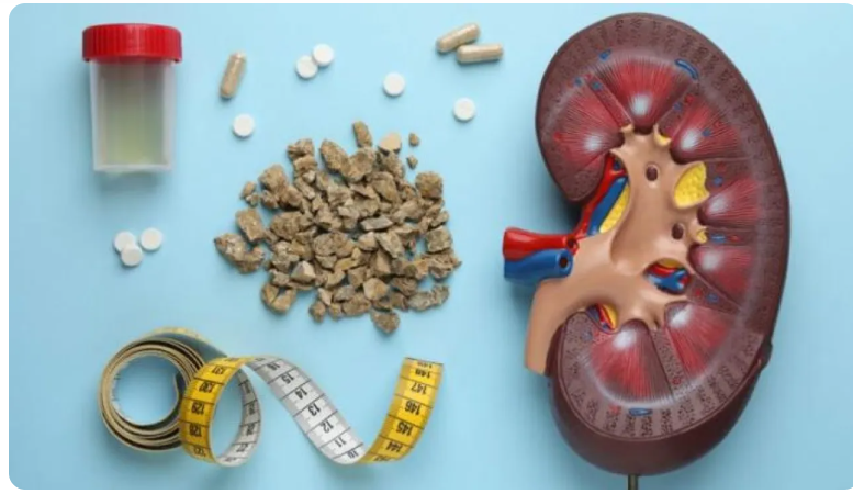 مفاجأة علمية: بكتيريا تشارك في تكوين حصوات الكلى