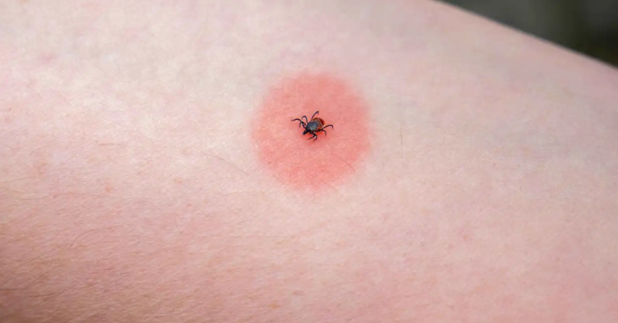 مع دخول الربيع ..  5 نصائح ذهبية لحماية نفسك من القراد أثناء التنزه