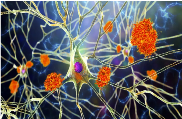اكتشاف سبب تدهور الذاكرة السريع لدى مرضى ألزهايمر