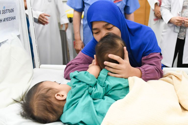 عملية فصل التوأم «أكيزا وعائشة» بالسعودية ..  7 ساعات لتحقيق المعجزة