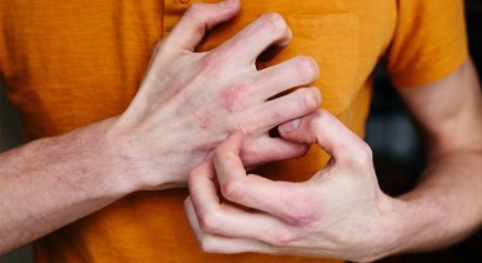 لتكن أكثر حذراً  ..  تعرّف على أسباب الإكزيما وأبرز أنواعها