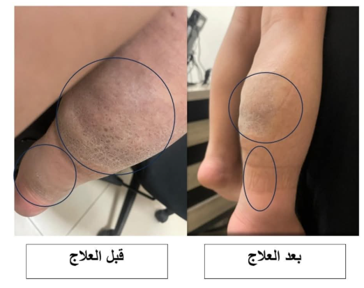علاج ورم نادر بالأشعة لطفل في مستشفى الملك المؤسس