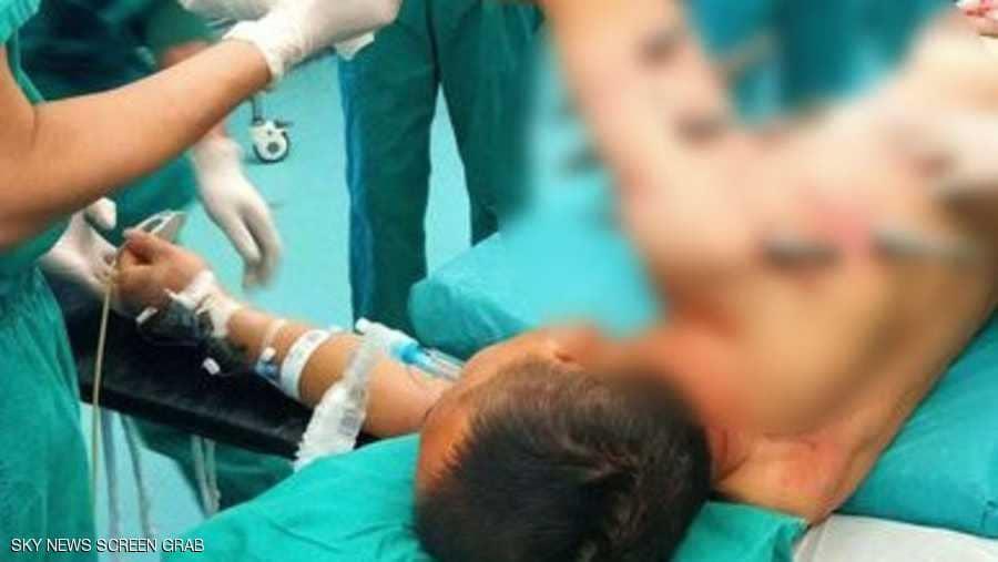 روبوت صناعي يغرز 10 قضبان معدنية بجسد عامل 