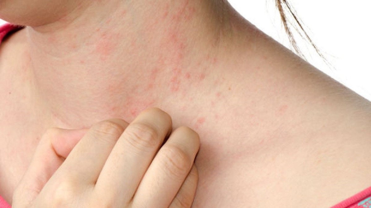 دراسة: الطفح الجلدي قد يكون أحد أعراض "كورونا"‎