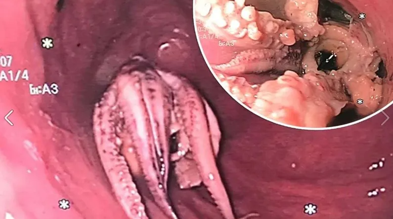 الأطباء ينقذون رجلا علق “أخطبوط” في حلقه