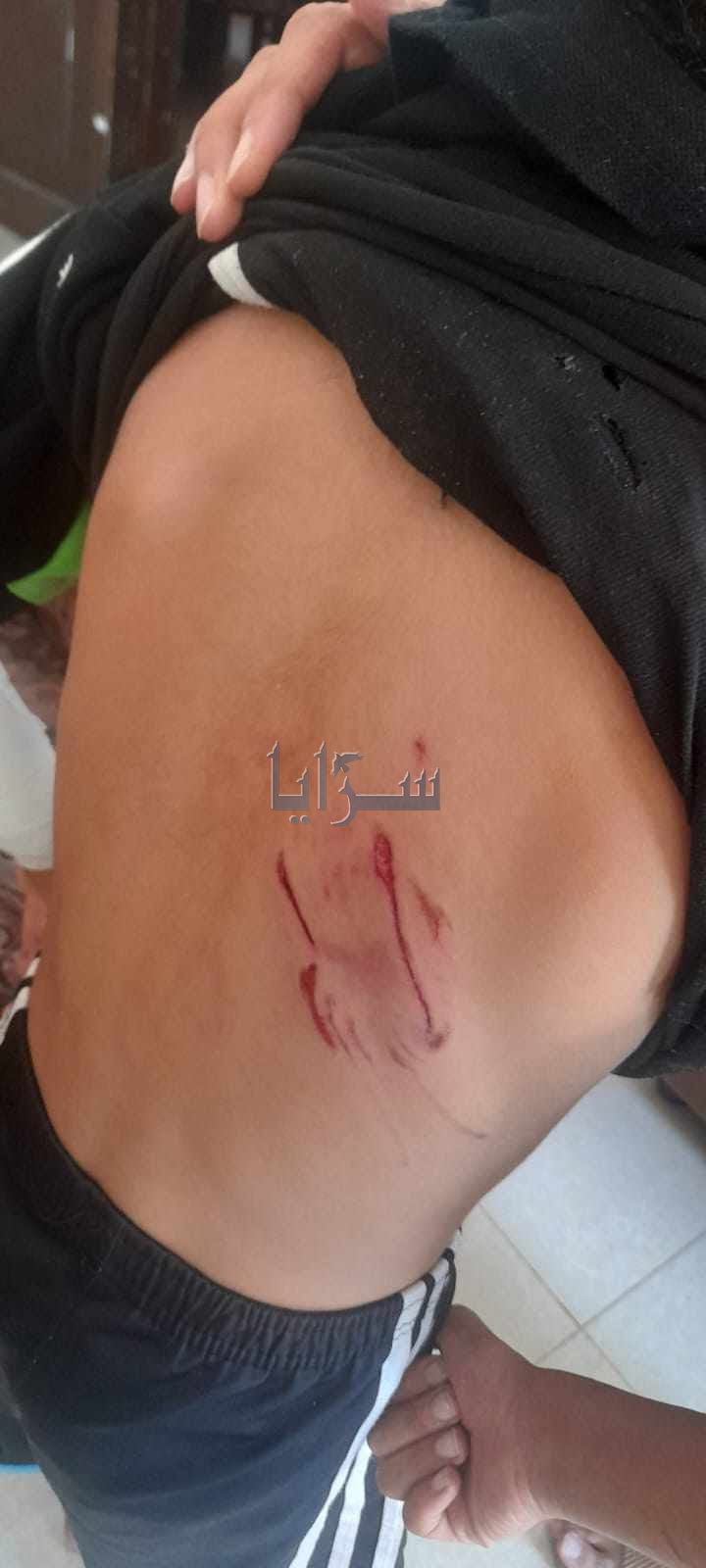 بالصور  ..  طفل من السلط يتعرض لهجوم كلب شرس  ..  والأهالي يطالبون بحل جذري 