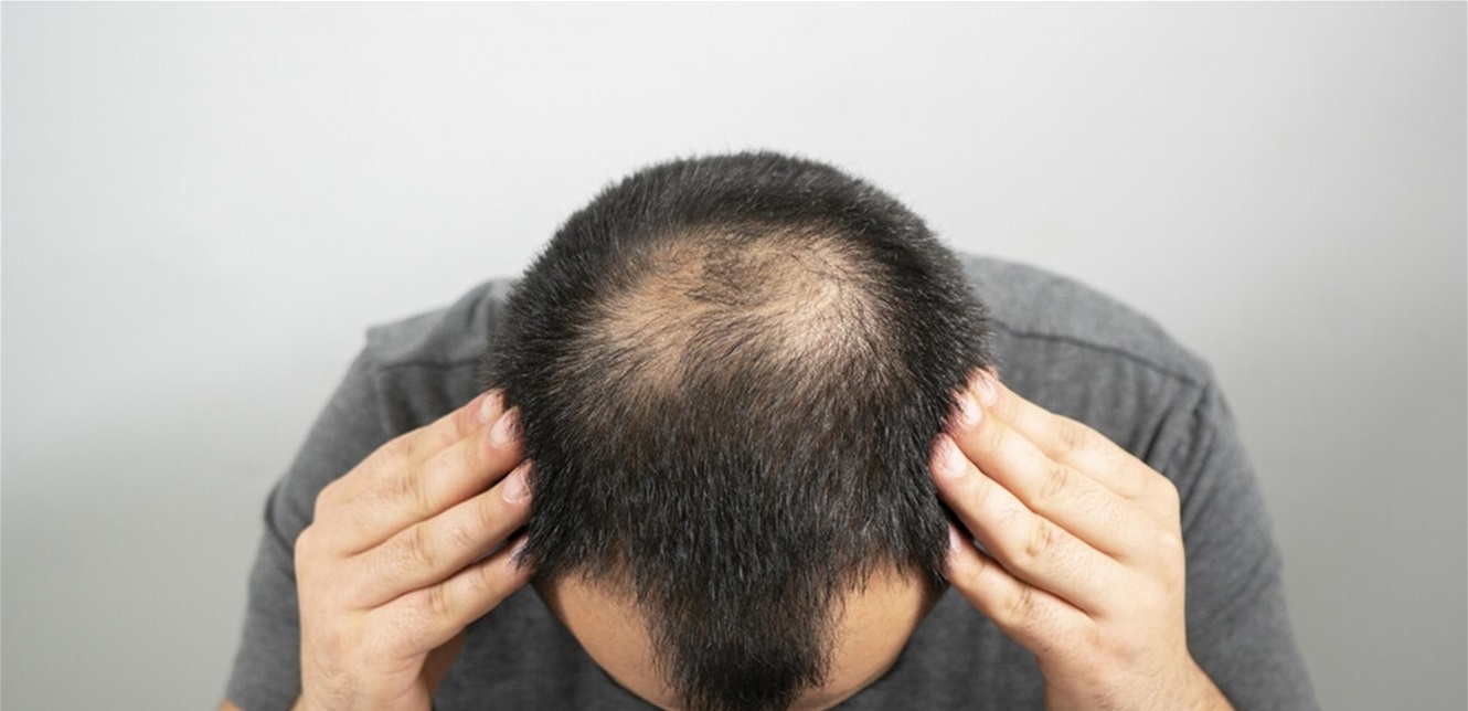 اكتشاف علاج طبيعي لتساقط الشعر