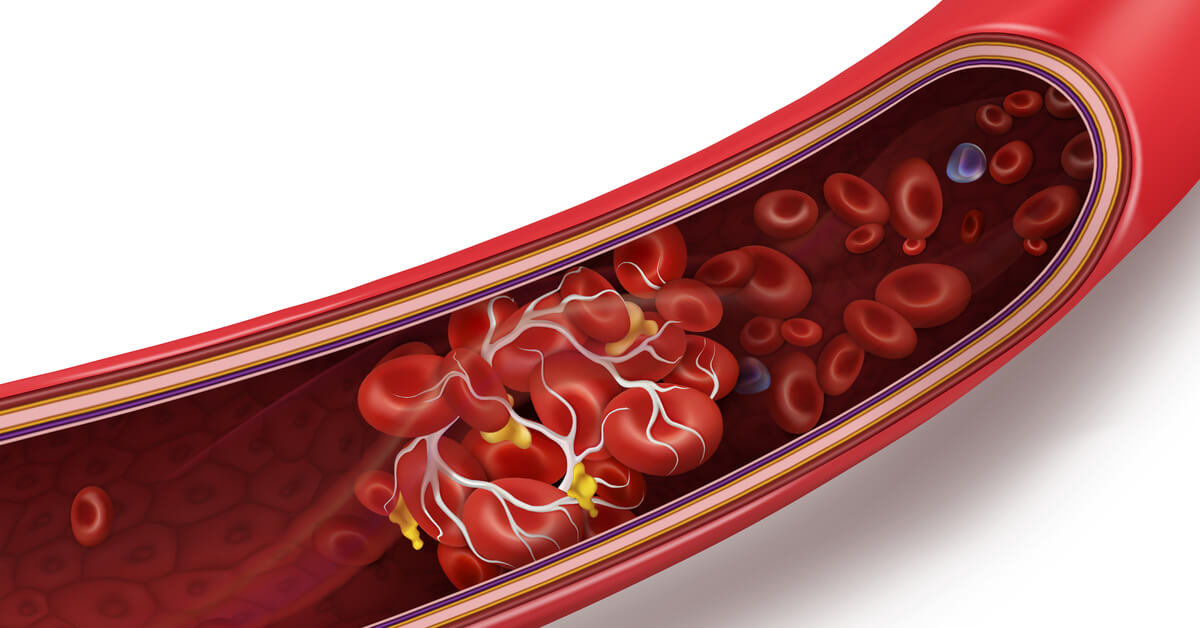 أطعمة يمكن أن "تمنع الدم من الحركة" وتسبب جلطات دموية خطيرة