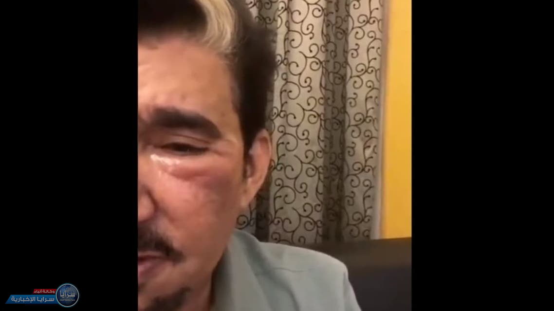 شاهد ..  عبدالله السدحان يتعرض لإصابة بالغة في الوجه