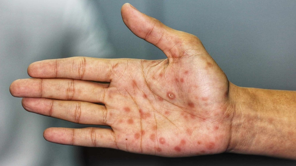 ألمانيا تسجّل رقماً قياسياً في إصابات "الزهري"
