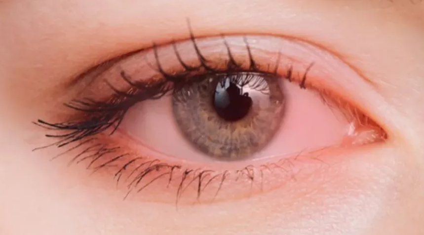 تغير لون العين المفاجئ ..  متى يكون علامة لمرض خطير؟