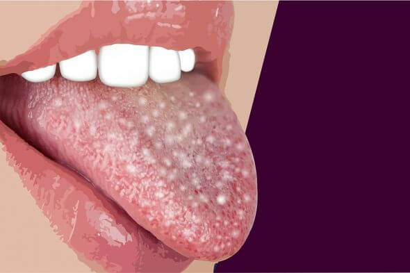 أسباب وعلاج بكتيريا الفم بالاعشاب الطبيعية