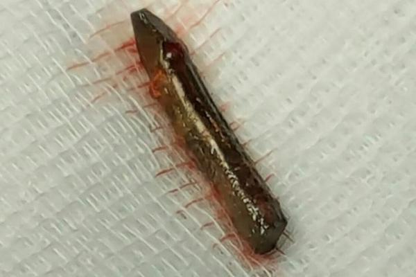 فريق طبي ينقذ عشرينيًّا اخترقت قلبه قطعة حديد بنجران