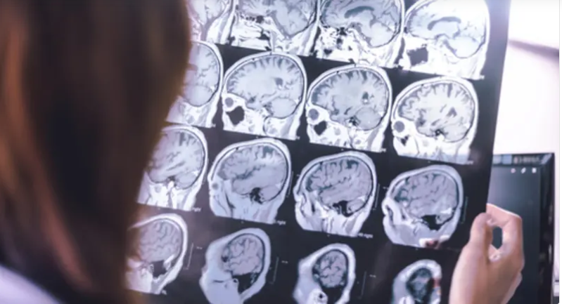 دراسة: خفض الكوليسترول يقلل خطر الإصابة بالخرف