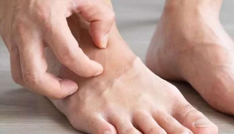 حكة القدمين قد تكشف أمراضا خطيرة