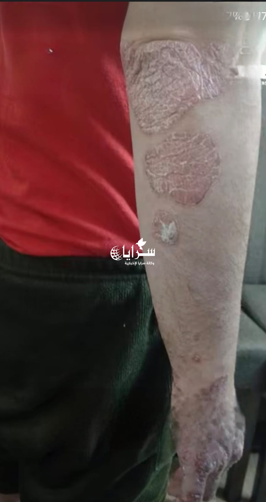 "مصاب بمرض جلدي نادر" ..   عائلة شاب أردني تناشد: "أنقذوا ابننا من ألمٍ لا يرحم"