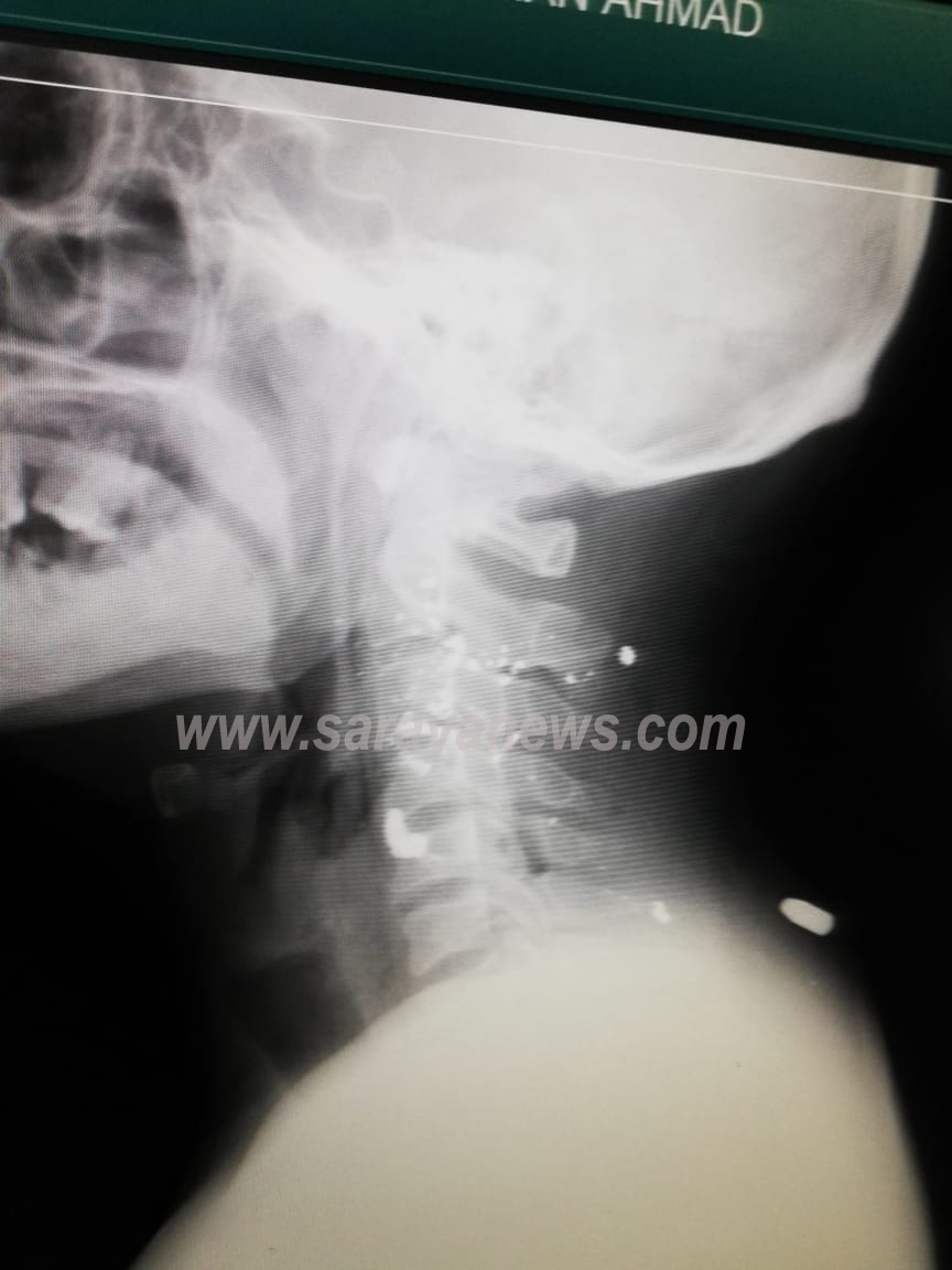 بالصور ..  استخراج رصاصة من عنق اربعيني في مستشفى الزرقاء الحكومي