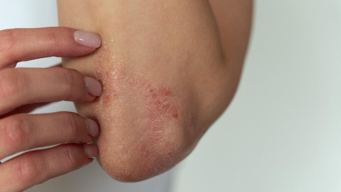 ما علاقة الجلد باضطراب النوم والذاكرة؟!