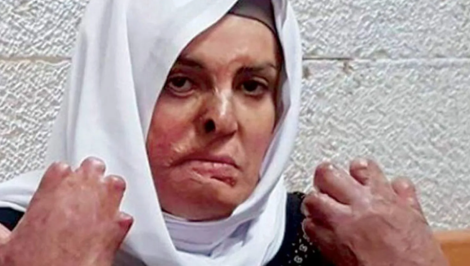 الأسيرة المحررة "جعابيص" تجري عمليتها الجراحية الـ 20 في الأردن
