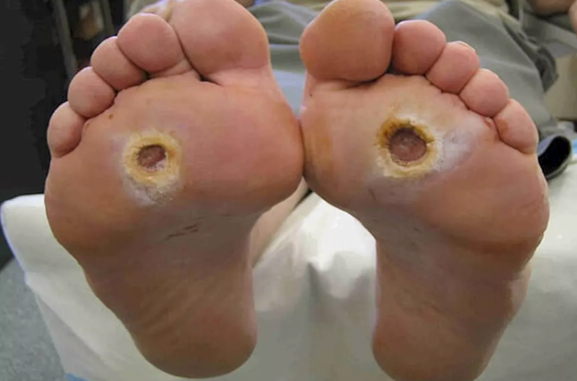 من هم الأشخاص المعرضون للإصابة بالقدم السكري؟