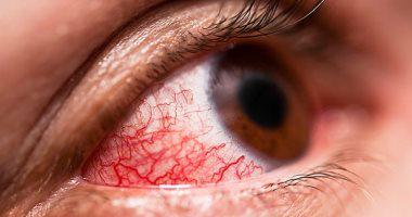 عينك مراية لصحتك ..  4 أمراض يمكن اكتشافها من العين أبرزها السكر والضغط