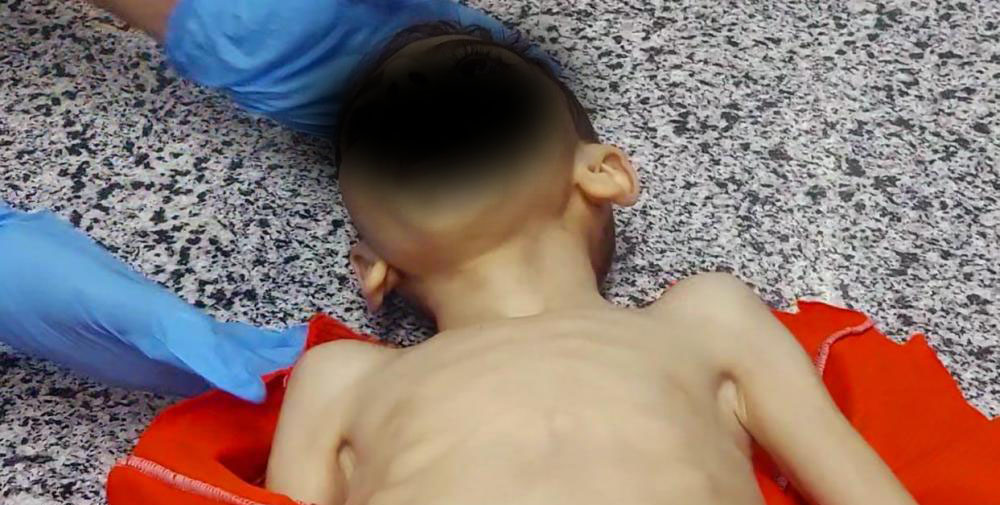 استشهاد طفل بغزة بسبب الجوع في غزة