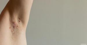 حقائق لا تعرفها عن التهاب الغدد العرقية القيحي