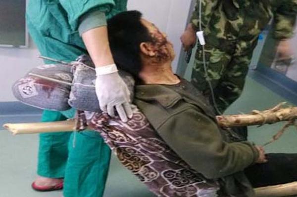 بالصور ..  "نجاة صيني" بعد أن اخترق جسده عامود خشبي بطول 6 أمتار