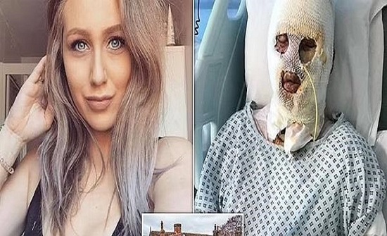لندن : مزحة تتسبب في تشويه وجه فتاة حسناء