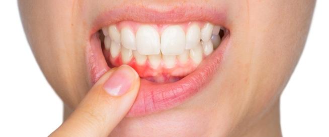 احذر 4 علامات تدل على التهاب اللثة