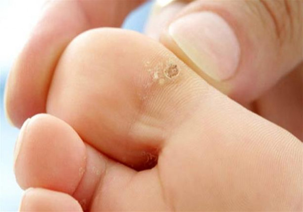 طريقة طبيعية لعلاج عين السمكة في المنزل