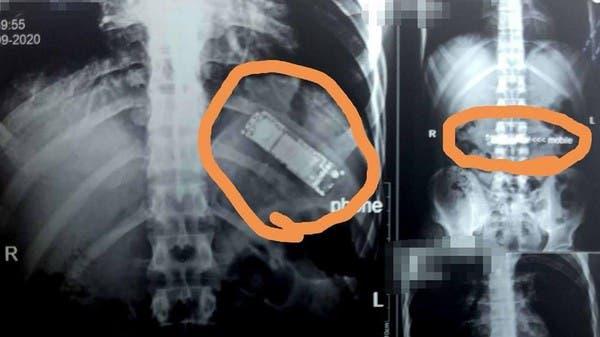 حادثة غريبة ..  هاتف في معدة شاب مصري لـ7 أشهر!